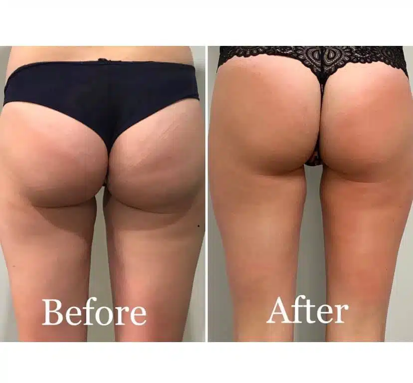 Rezultat Velashape 3