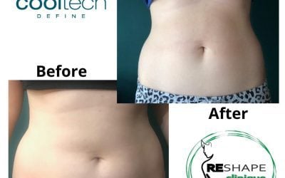Remodelarea corporală: Criolipoliza CrioSculpting Define si Velashape 3