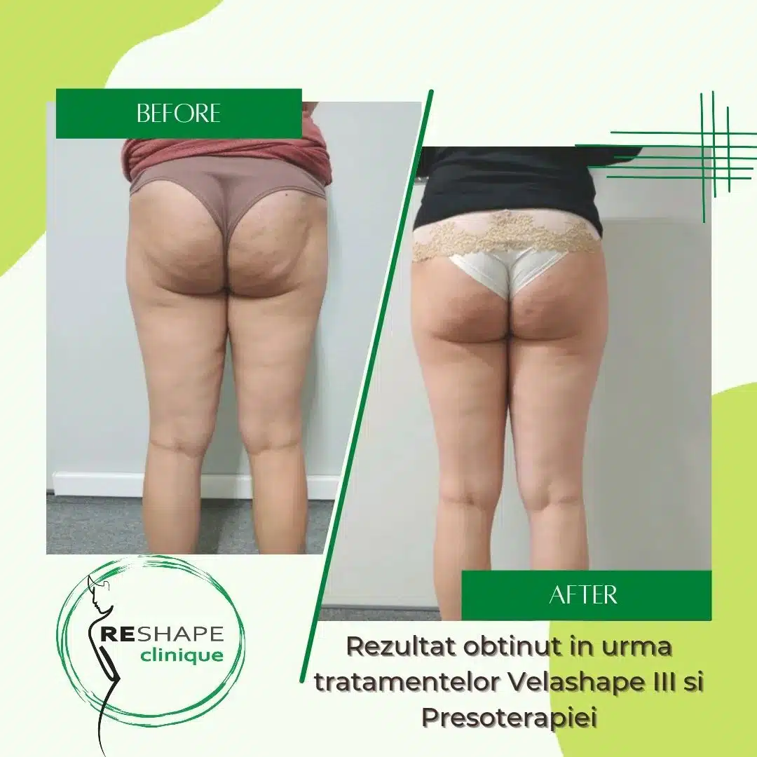 Rezultat Velashape 3 inaint si dupa